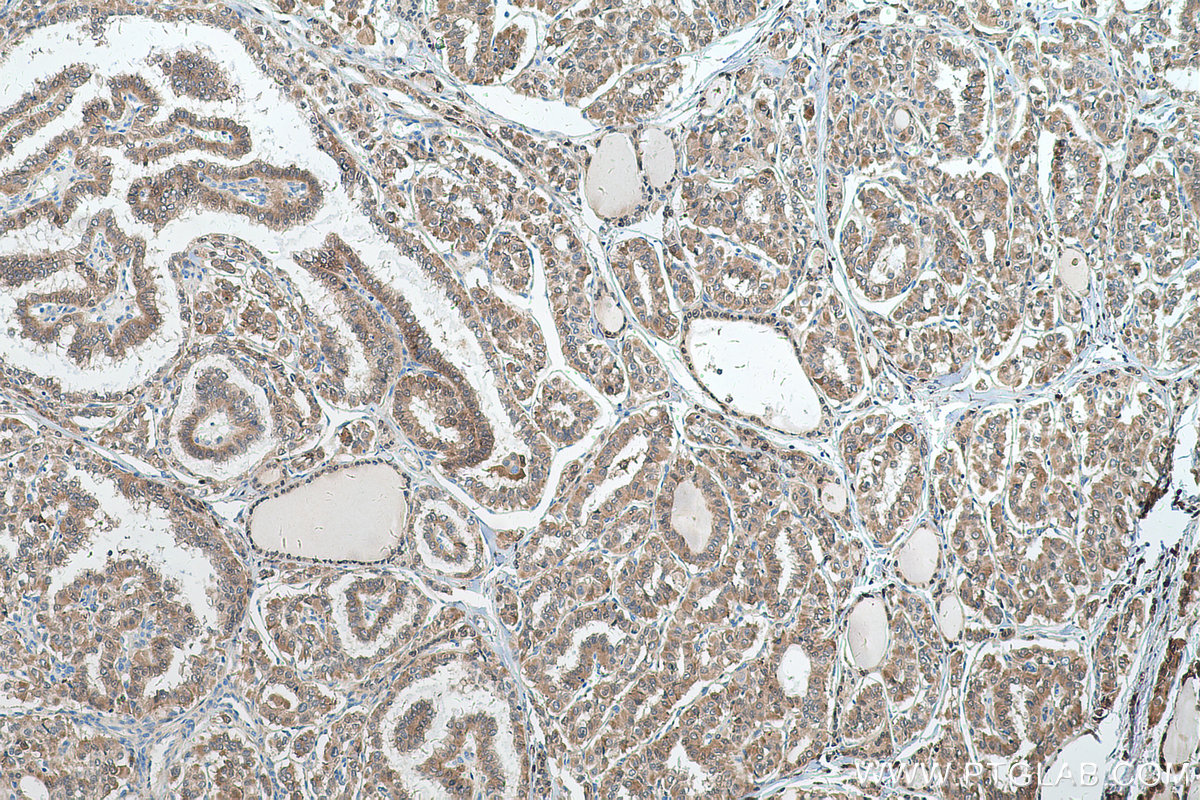 IHC staining of human thyroid cancer using 15054-1-AP