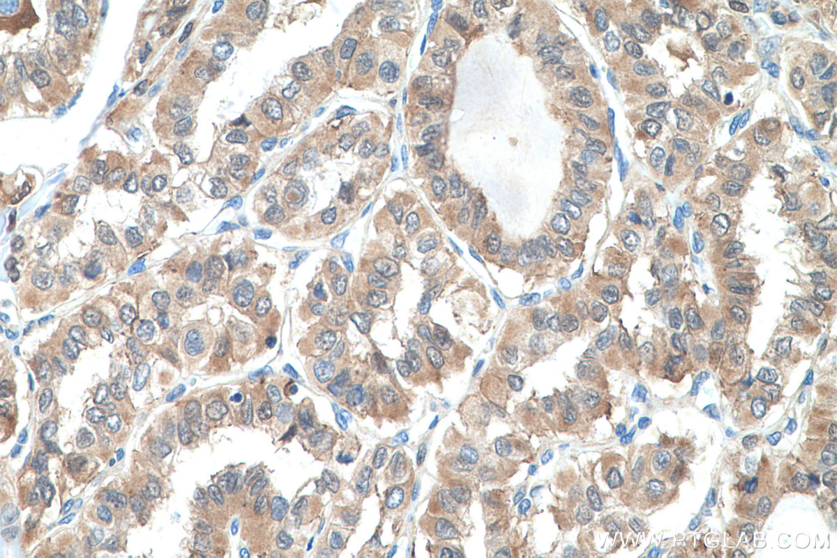 IHC staining of human thyroid cancer using 15054-1-AP