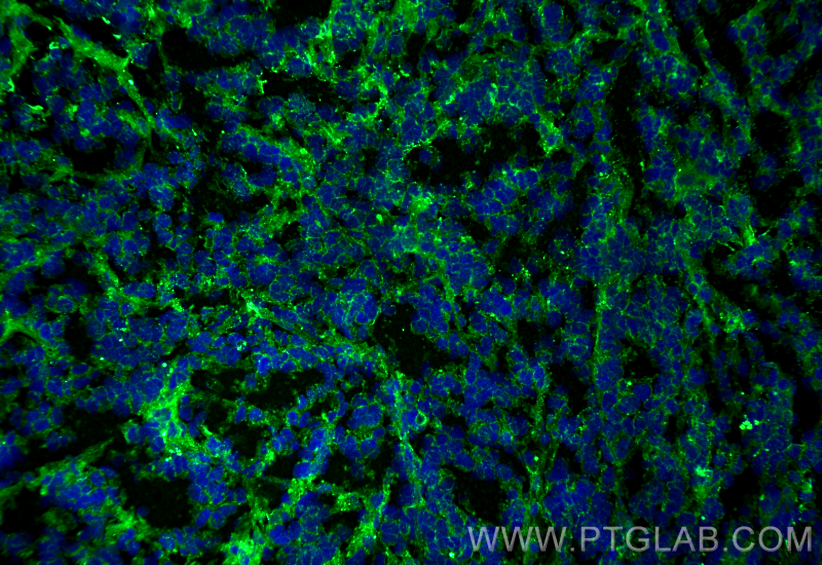 IF Staining of mouse breast cancer using 67768-1-Ig (same clone as 67768-1-PBS)