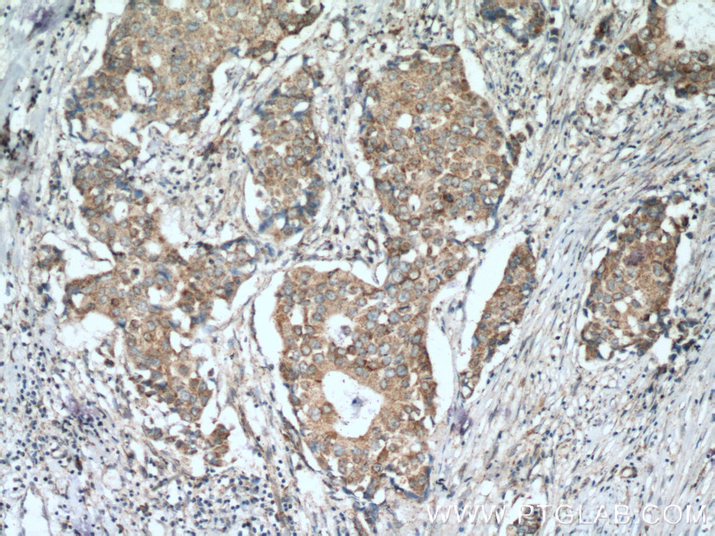 IHC staining of human breast cancer using 17719-1-AP