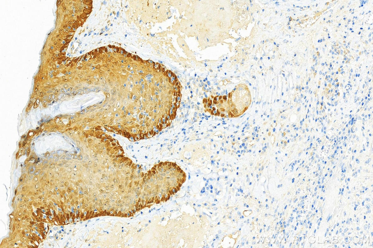 IHC staining of human skin cancer using 15578-1-AP