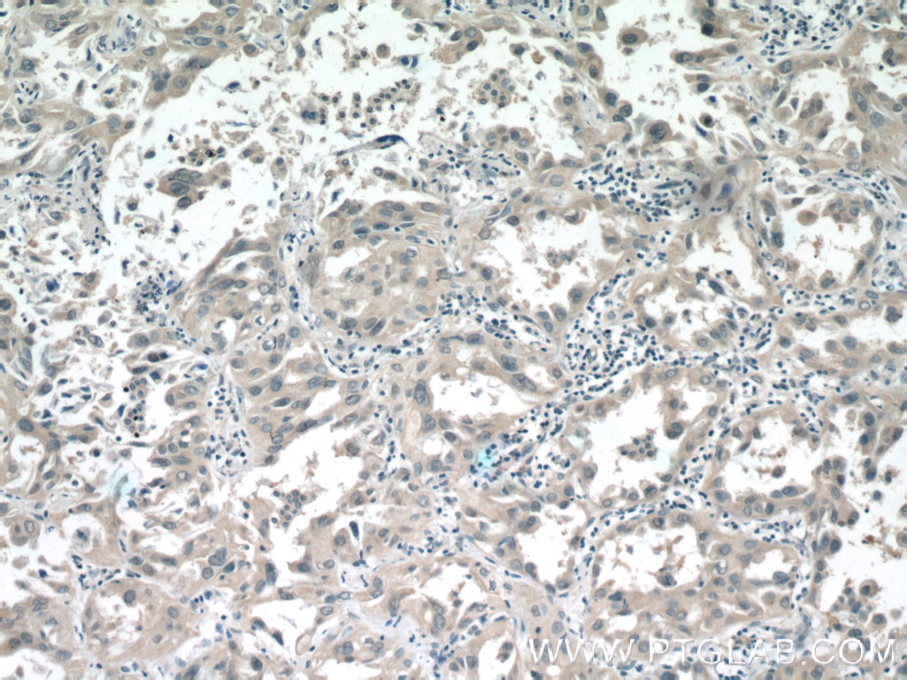 IHC staining of human lung cancer using 19446-1-AP