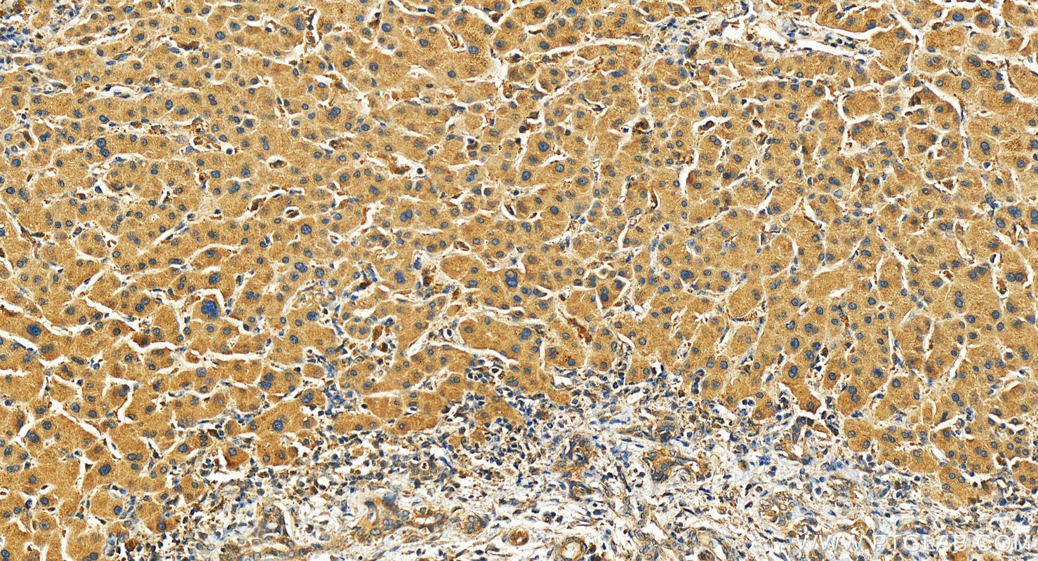 IHC staining of human intrahepatic cholangiocarcinoma using 27085-1-AP