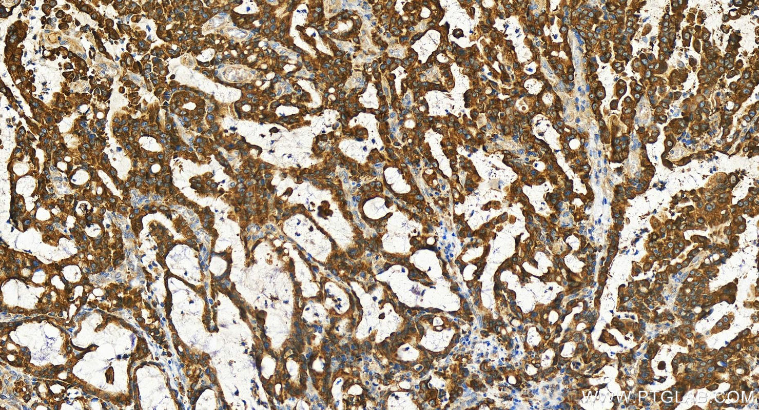 IHC staining of human stomach cancer using 29218-1-AP