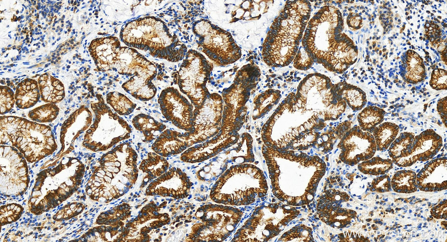 IHC staining of human stomach cancer using 29218-1-AP