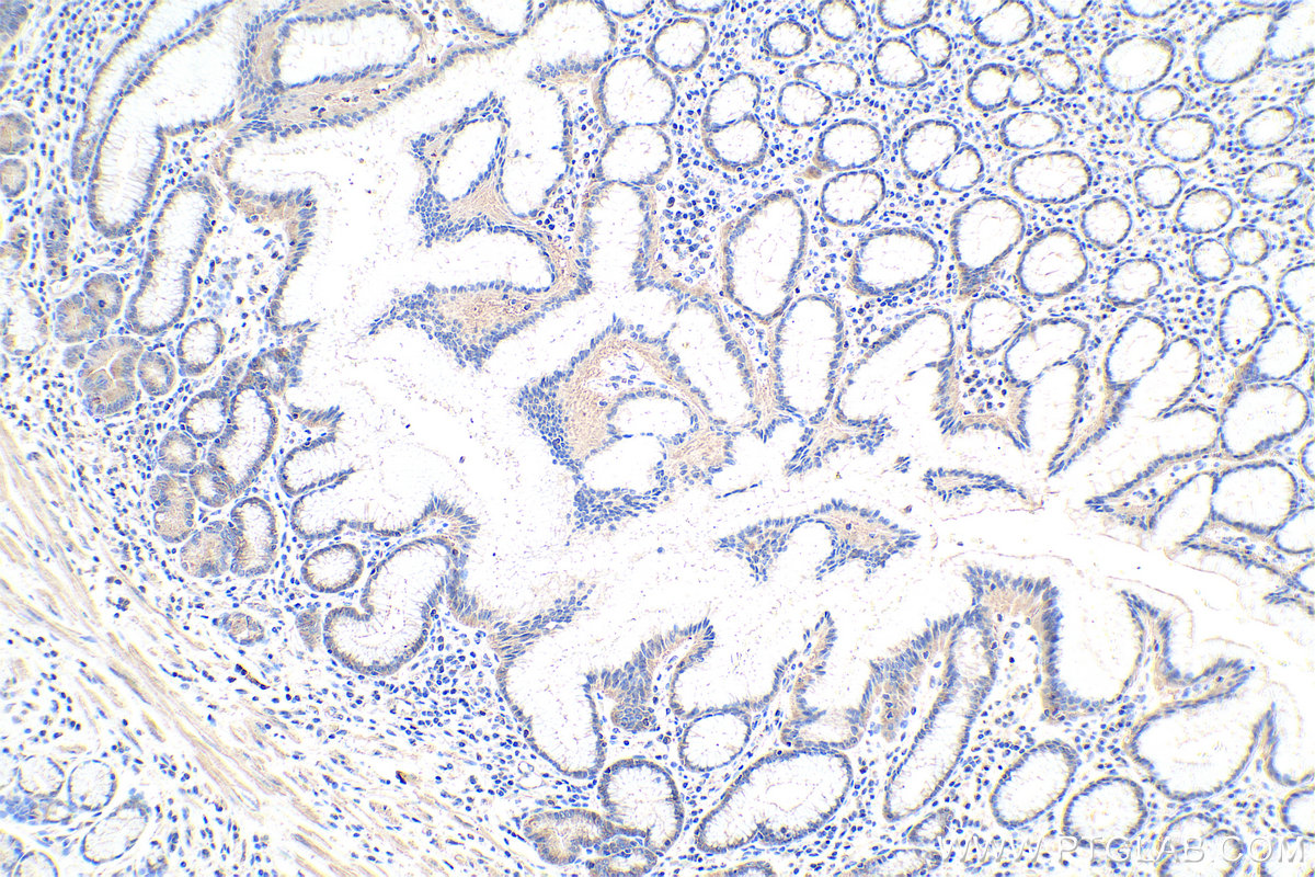 IHC staining of human stomach cancer using 67715-1-Ig (same clone as 67715-1-PBS)