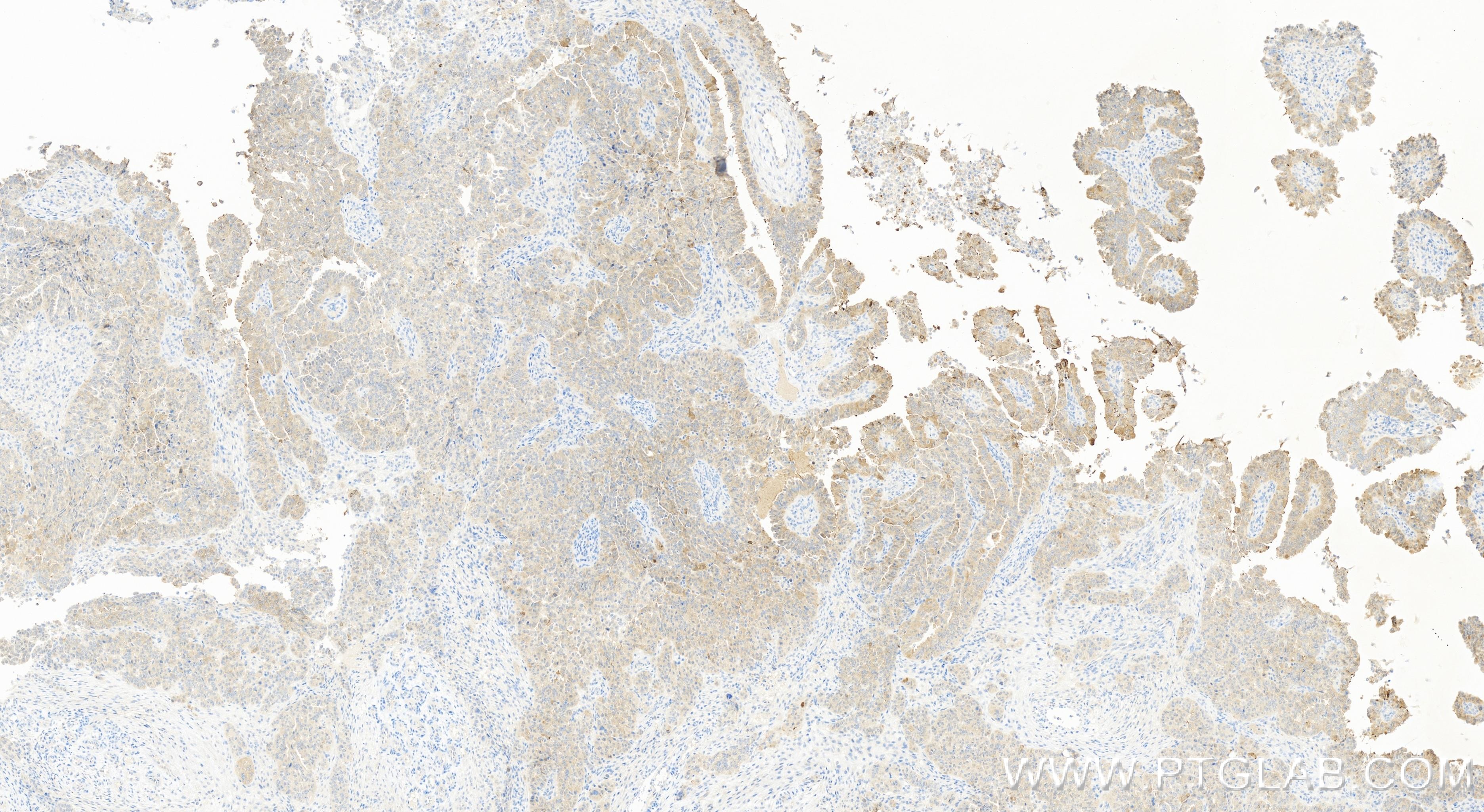 IHC staining of human ovary cancer using 84153-5-RR (same clone as 84153-5-PBS)