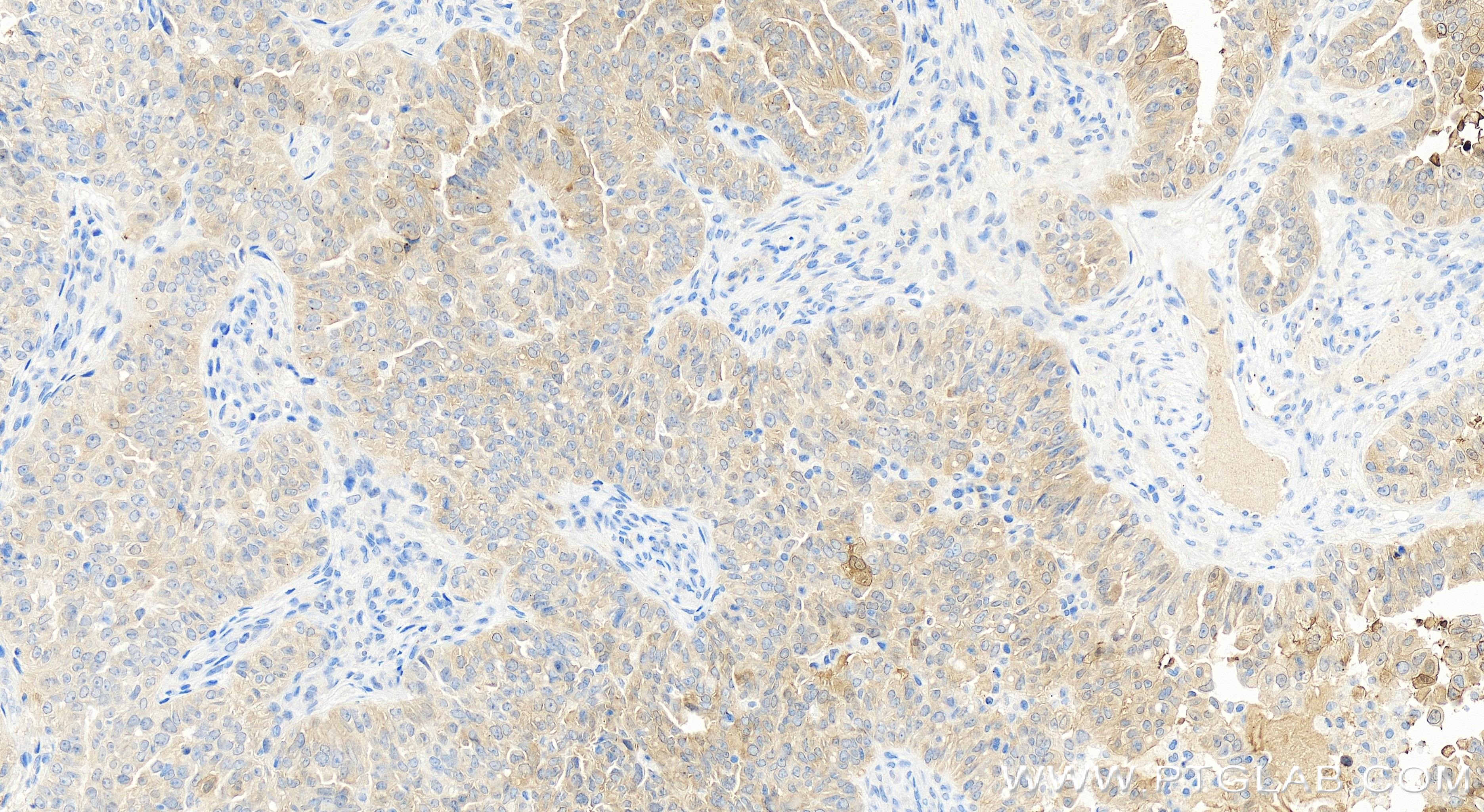 IHC staining of human ovary cancer using 84153-5-RR (same clone as 84153-5-PBS)