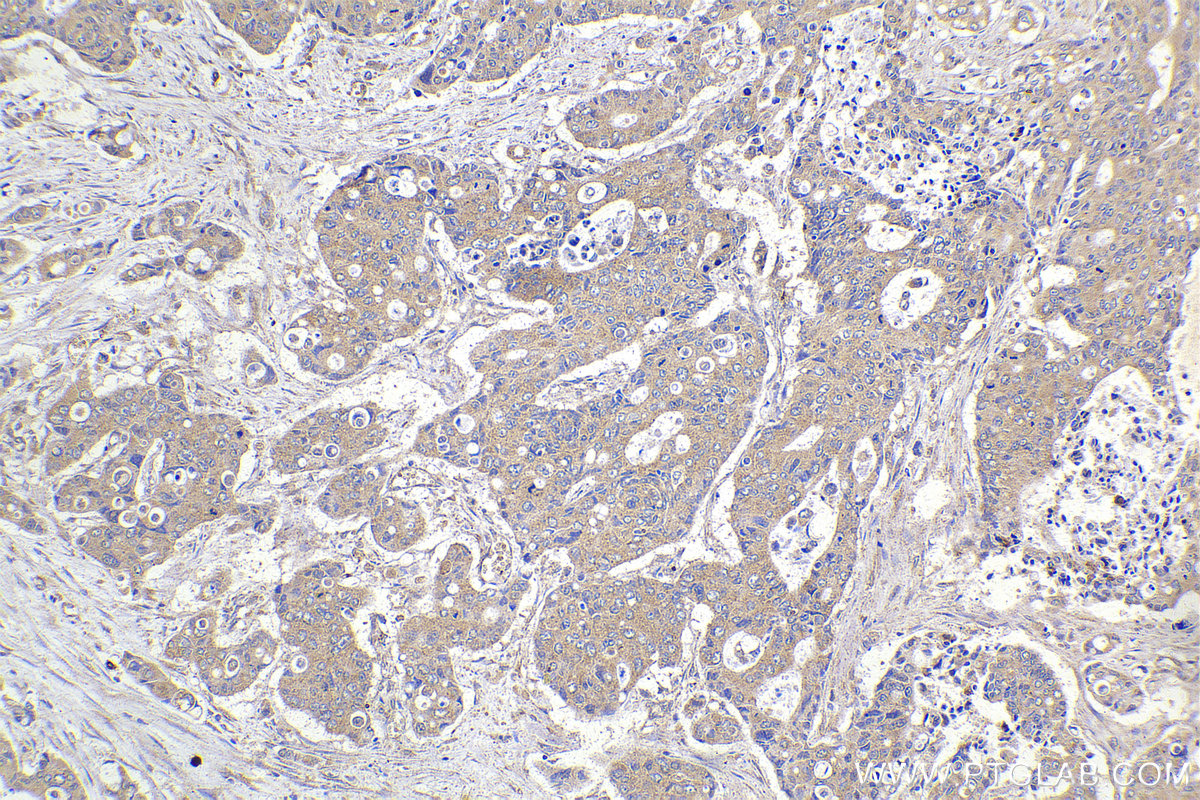 IHC staining of human stomach cancer using 23938-1-AP