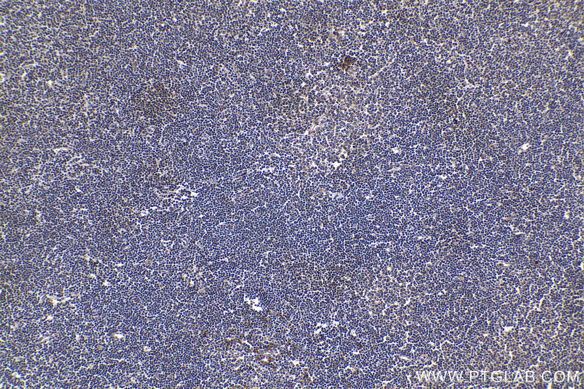 IHC staining of human lymphoma using 23938-1-AP