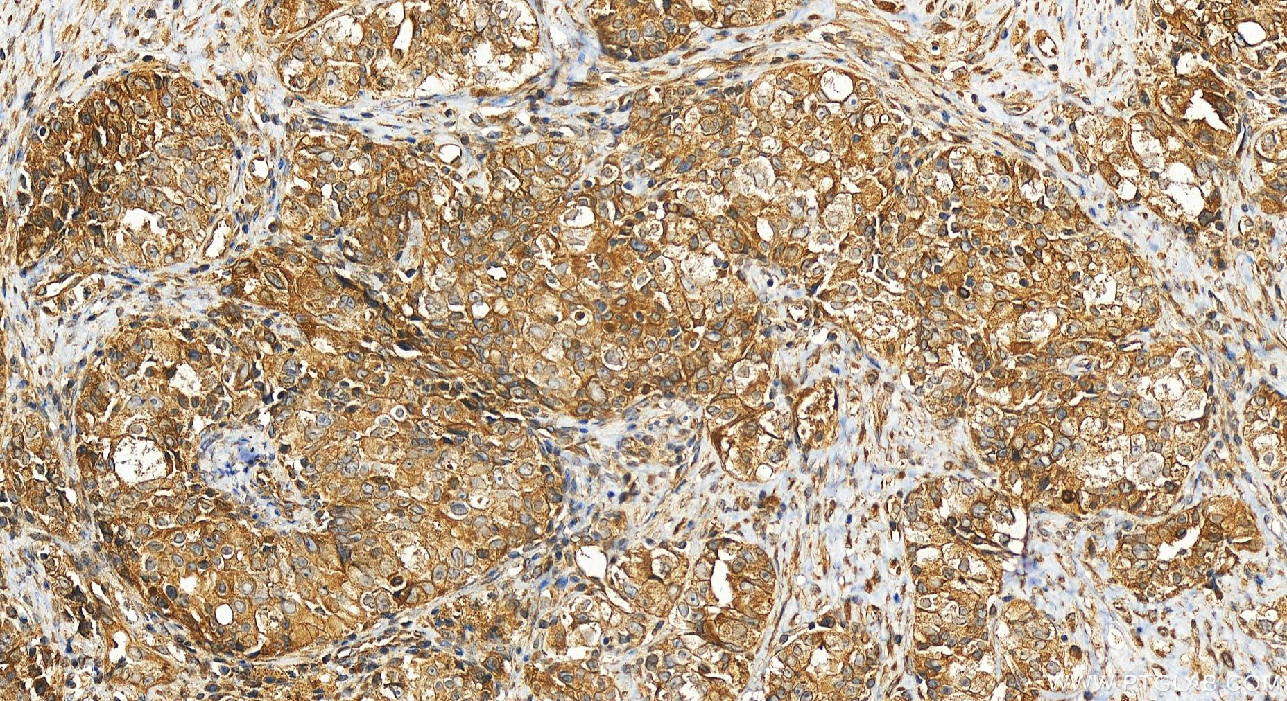 IHC staining of human ovary cancer using 26293-1-AP