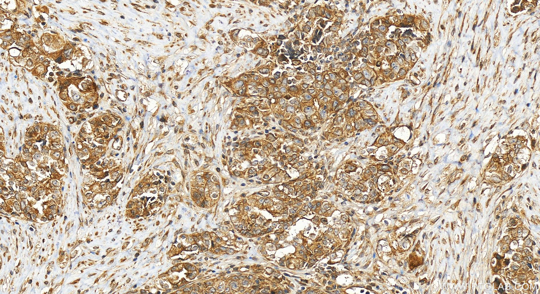 IHC staining of human ovary cancer using 26293-1-AP