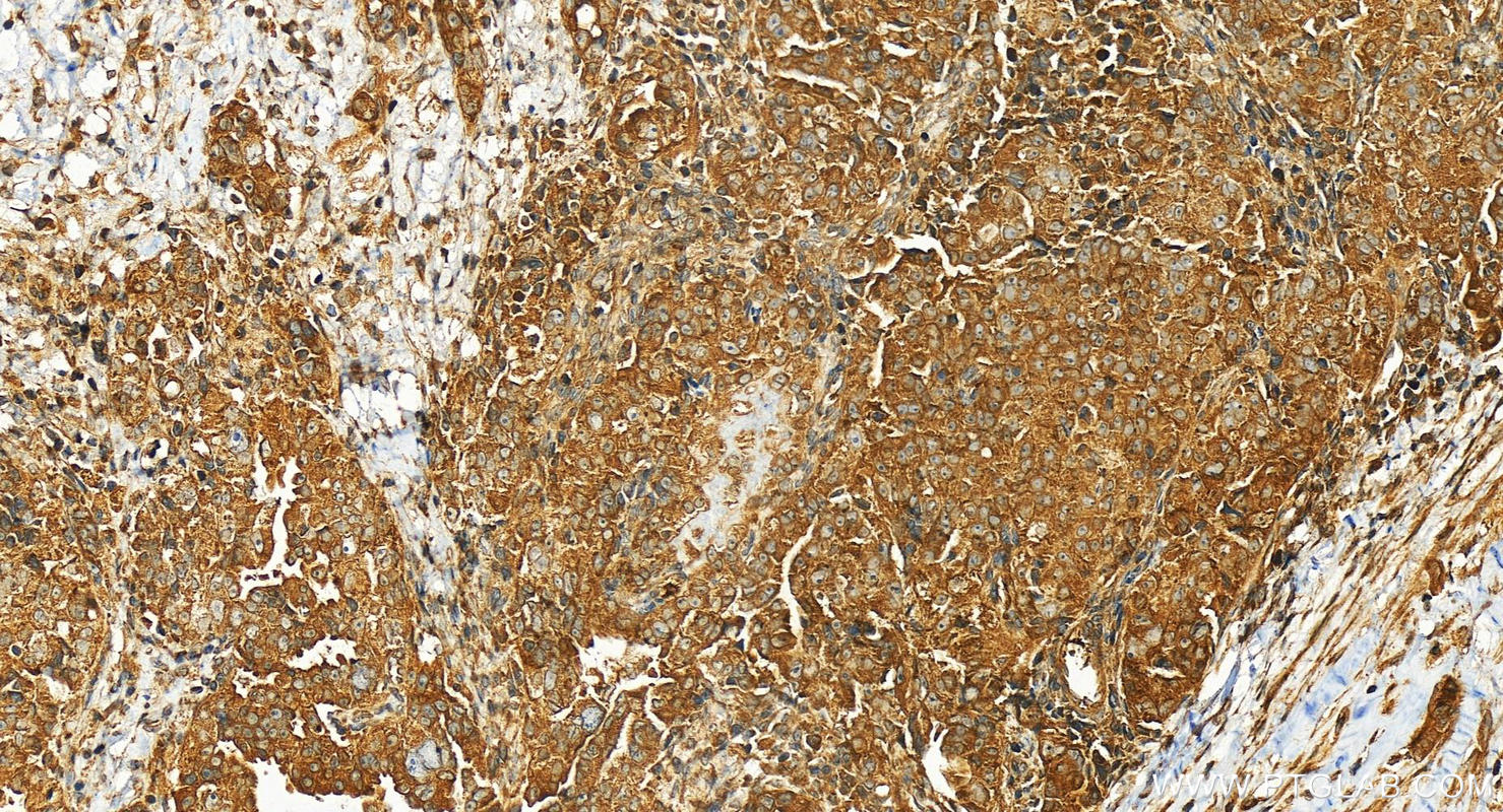 IHC staining of human ovary cancer using 24334-1-AP