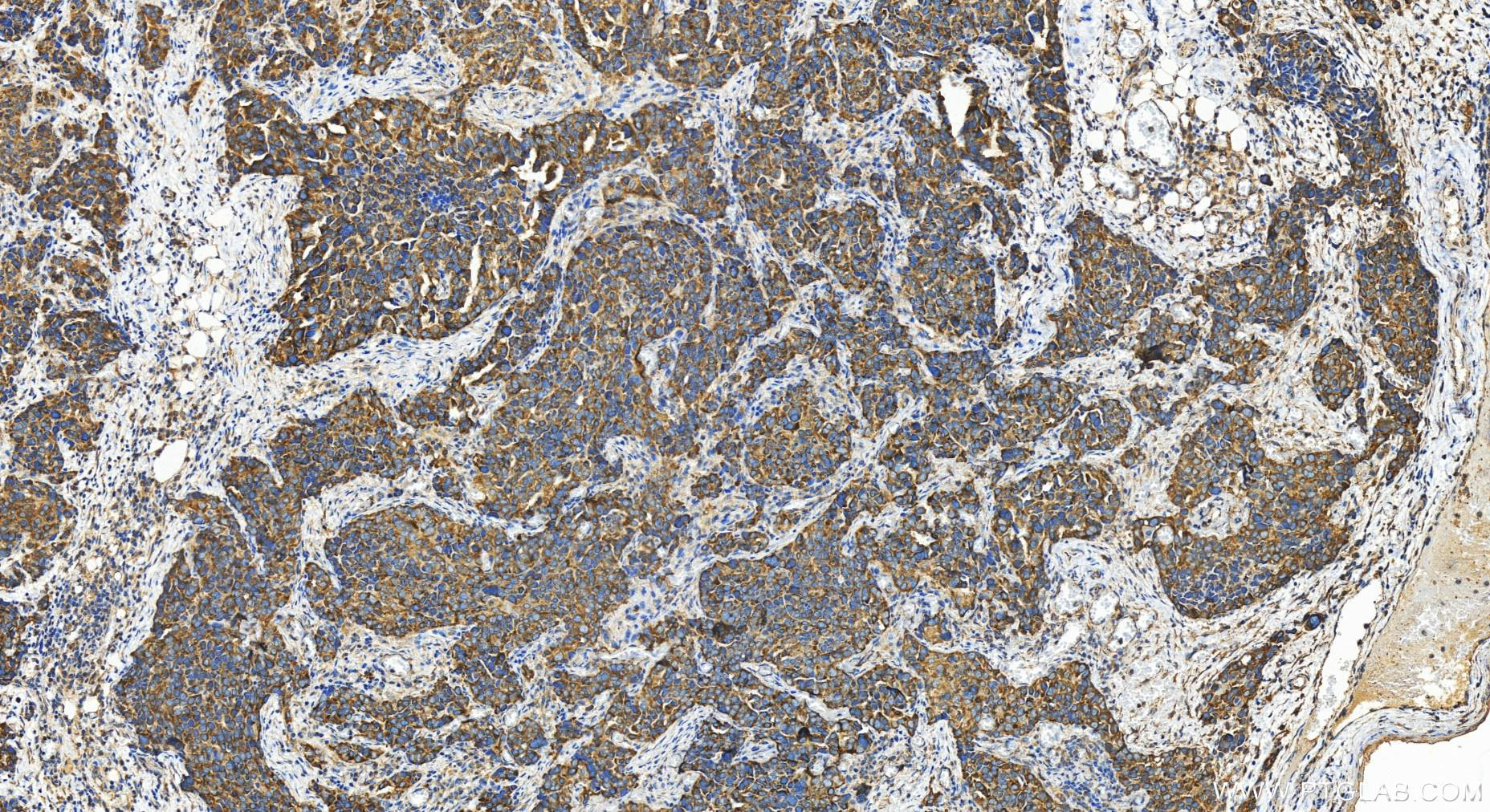 IHC staining of human ovary cancer using 27701-1-AP