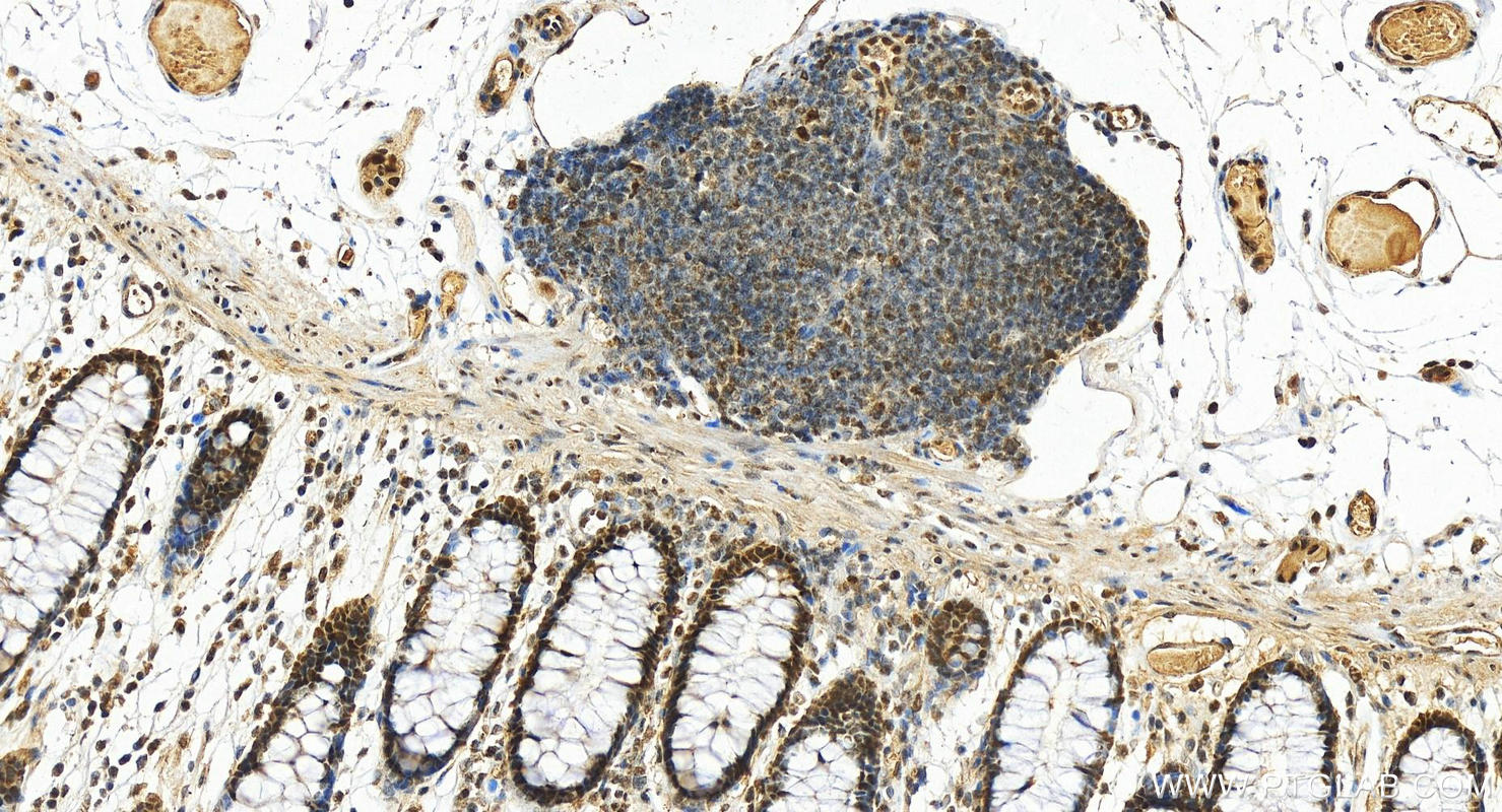 IHC staining of human colon using 10843-1-AP