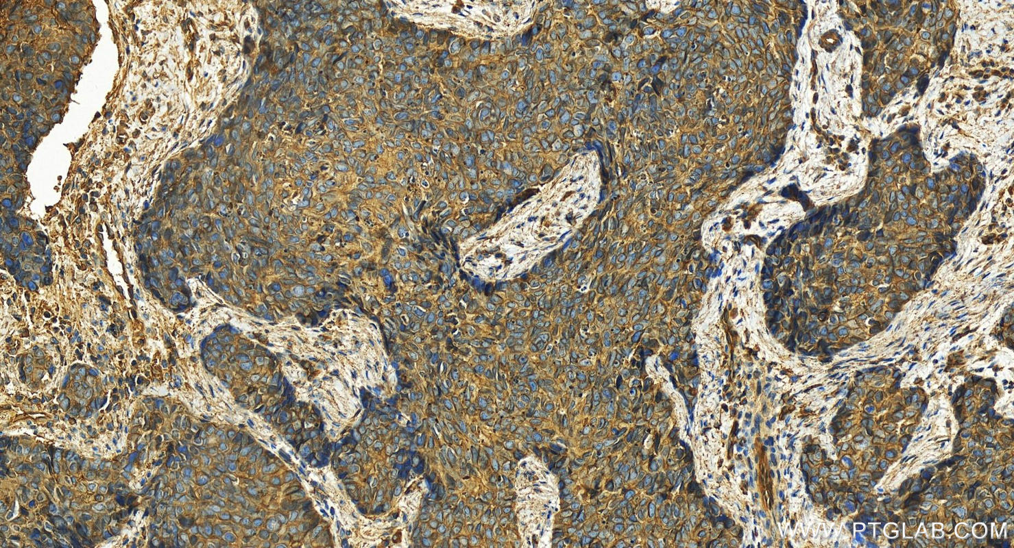 IHC staining of human bowen disease using 11256-1-AP