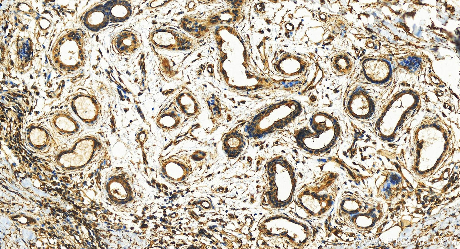 IHC staining of human bowen disease using 11256-1-AP