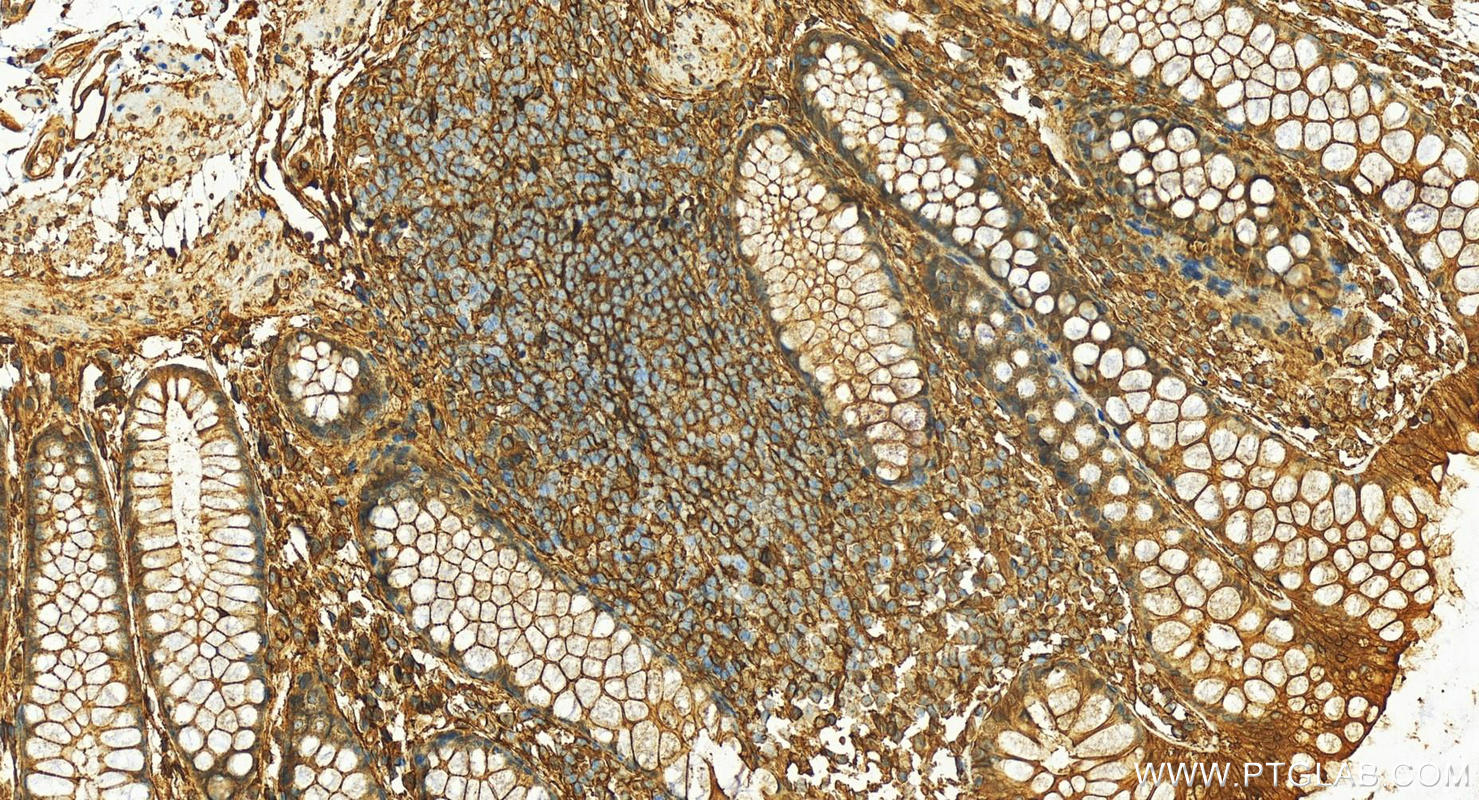 IHC staining of human colon using 10087-1-AP (same clone as 10087-1-PBS)