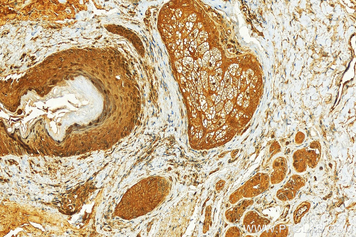 IHC staining of human skin cancer using 22114-1-AP