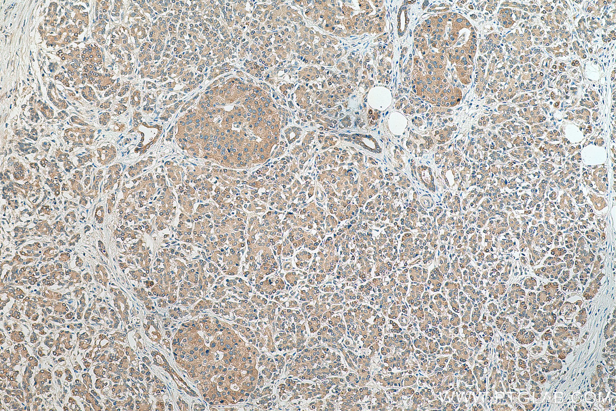 IHC staining of human pancreas cancer using 10618-1-AP