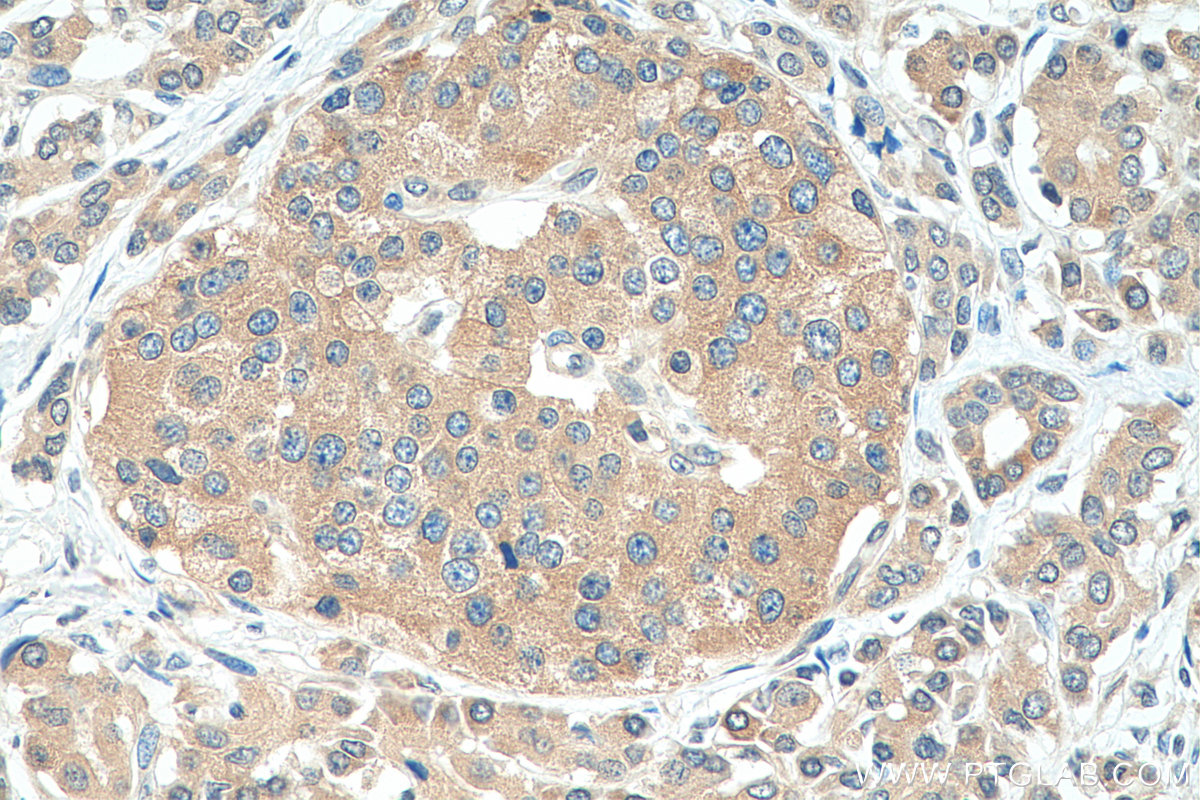 IHC staining of human pancreas cancer using 10618-1-AP