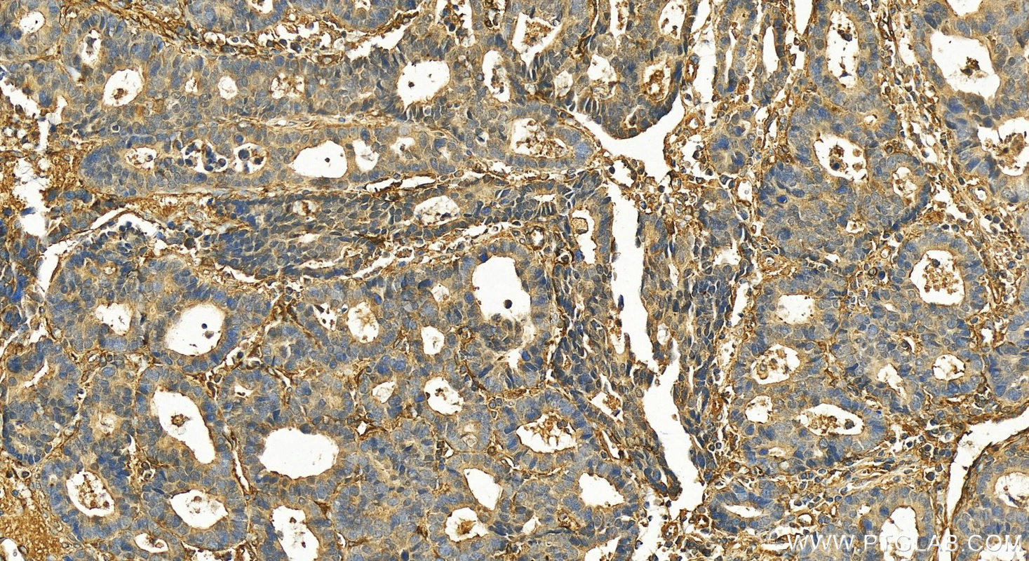 IHC staining of human stomach cancer using 30030-1-AP