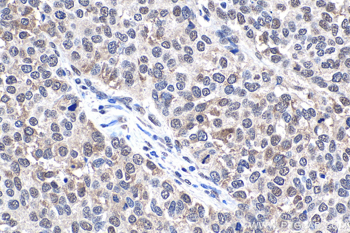 IHC staining of human stomach cancer using 10203-1-AP