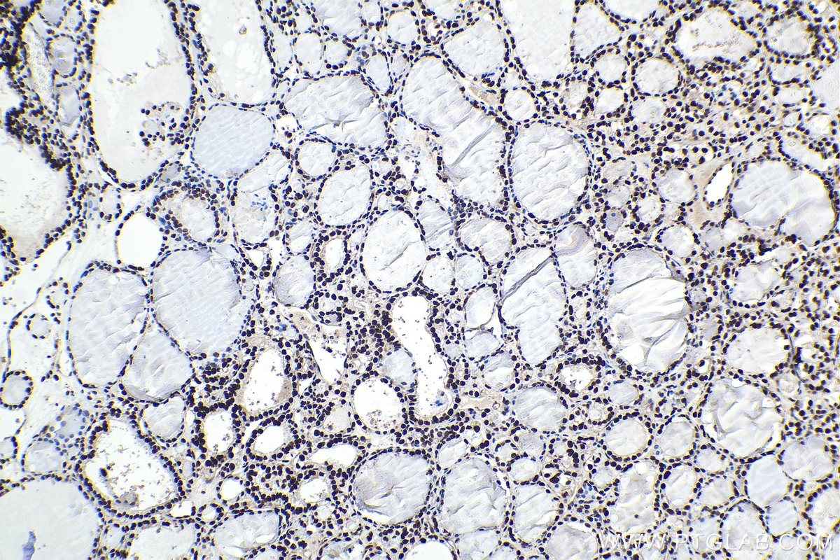 IHC staining of human thyroid cancer using 10203-1-AP