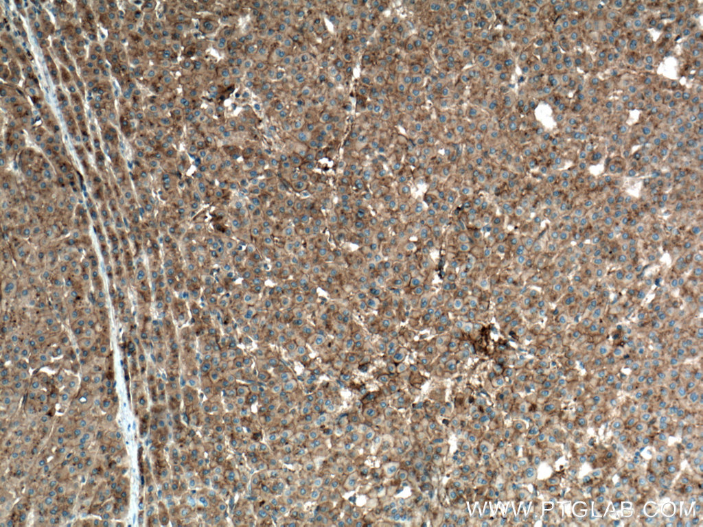 IHC staining of human liver cancer using 66773-1-Ig (same clone as 66773-1-PBS)