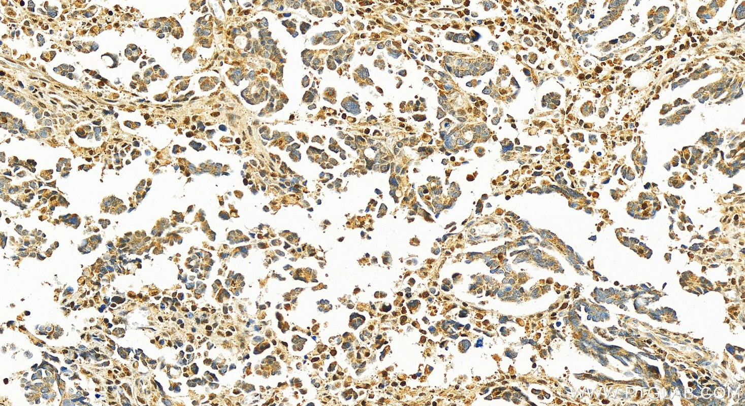 IHC staining of human ovary cancer using 10591-1-AP