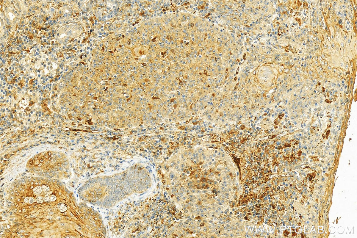 IHC staining of human skin cancer using 18254-1-AP