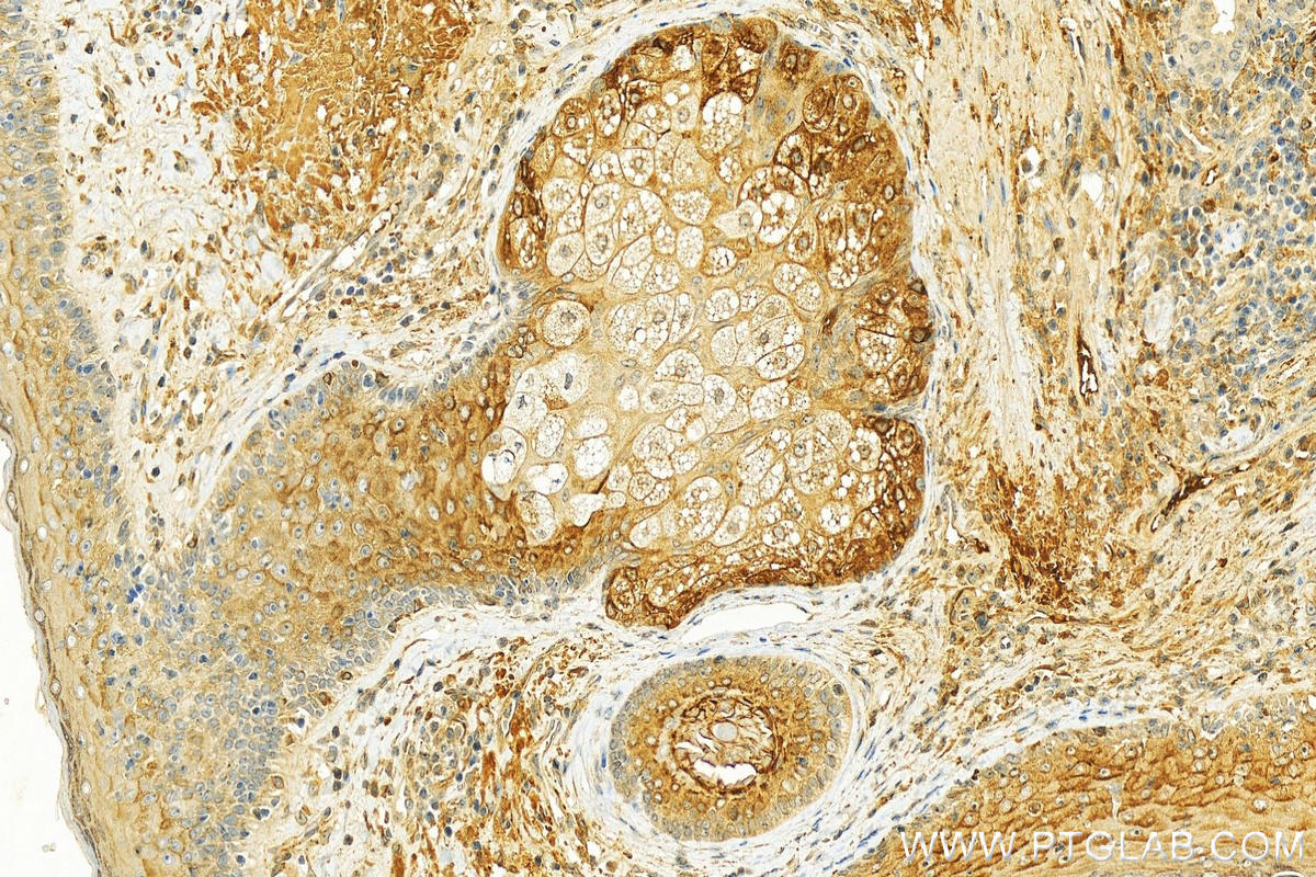 IHC staining of human skin cancer using 18254-1-AP