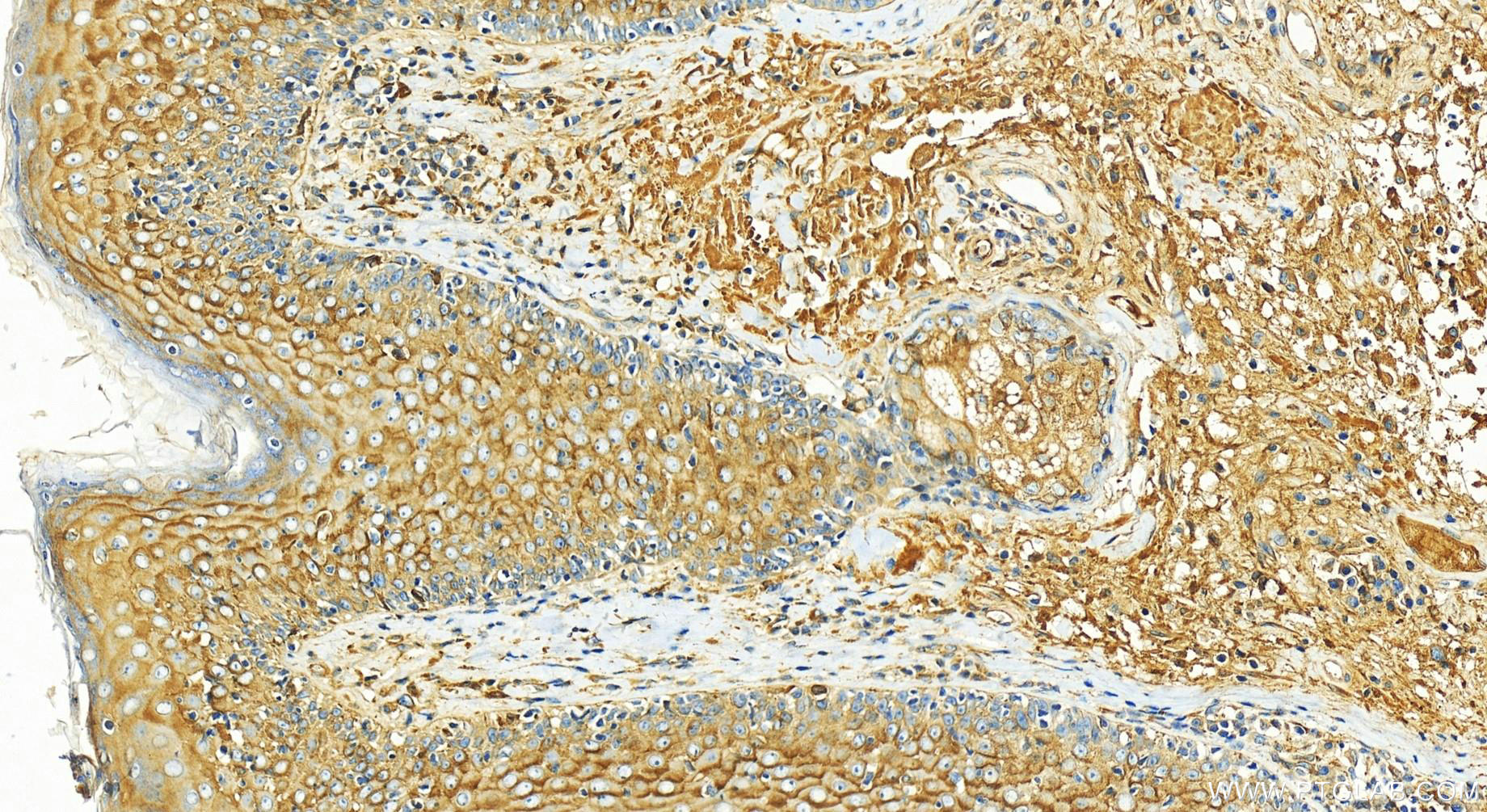 IHC staining of human skin cancer using 30535-1-AP