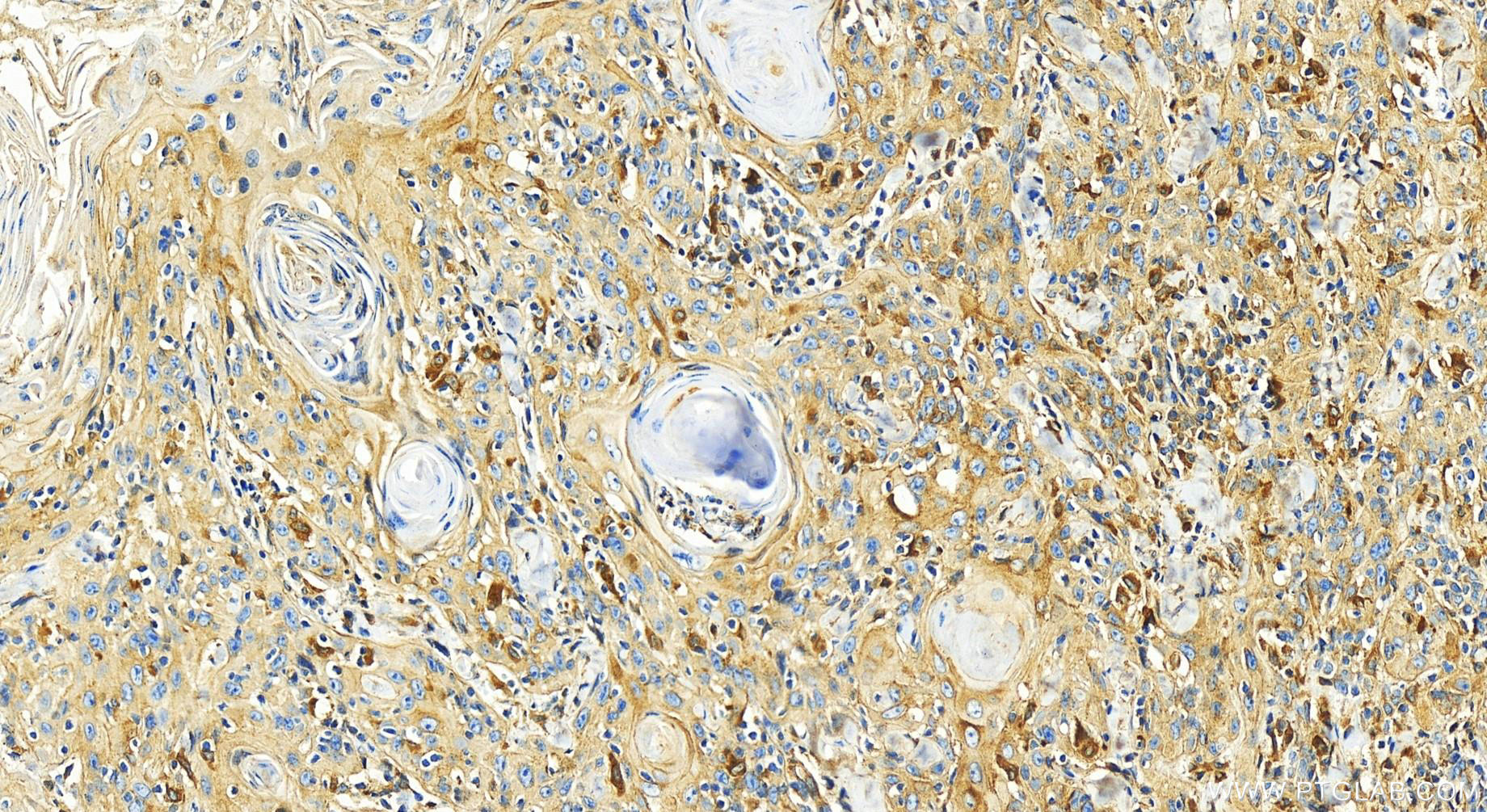 IHC staining of human skin cancer using 30535-1-AP