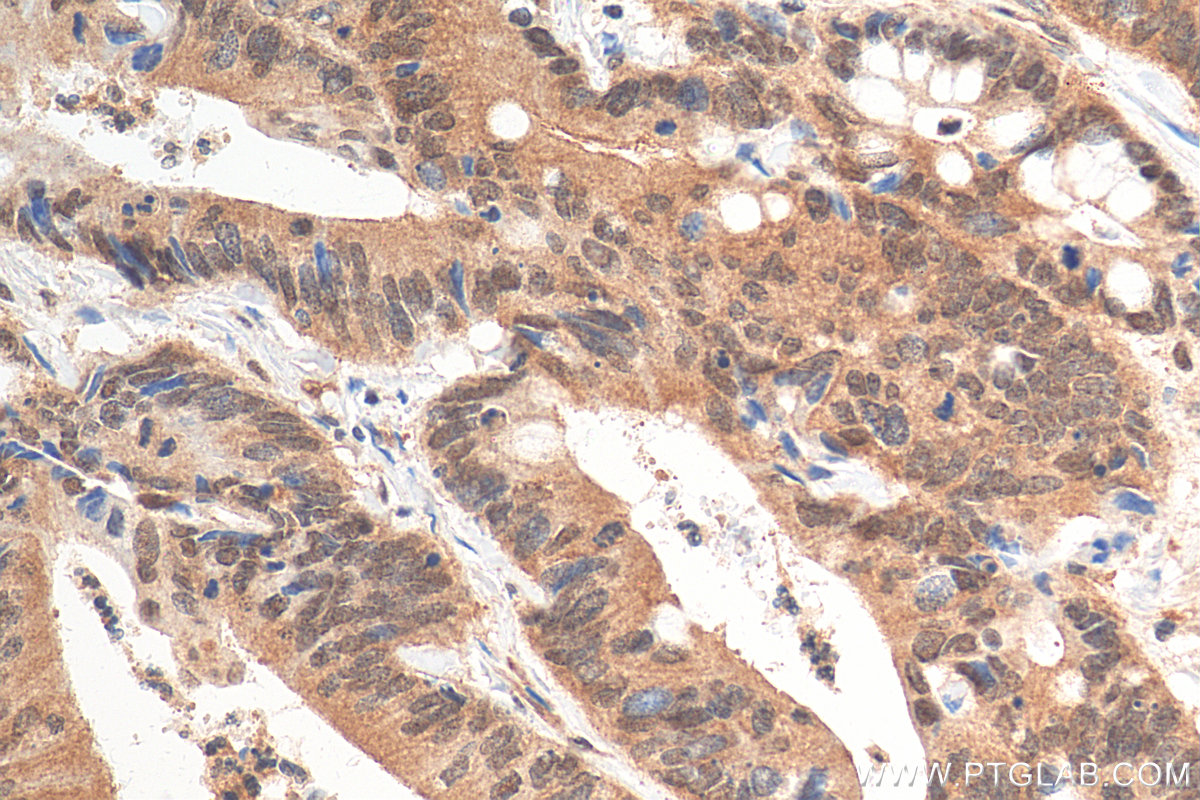 IHC staining of human colon cancer using 68195-1-Ig