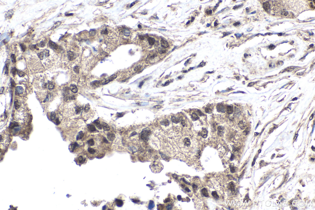 IHC staining of human pancreas cancer using 14294-1-AP