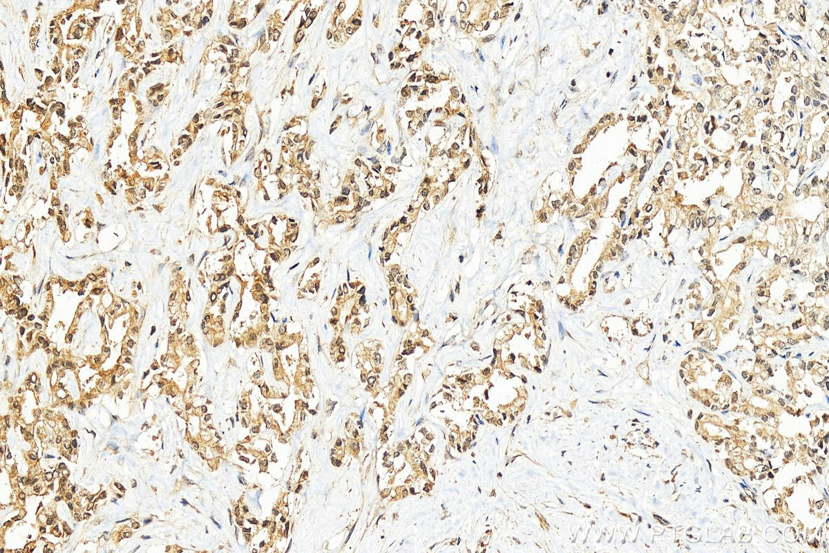 IHC staining of human intrahepatic cholangiocarcinoma using 10680-1-AP