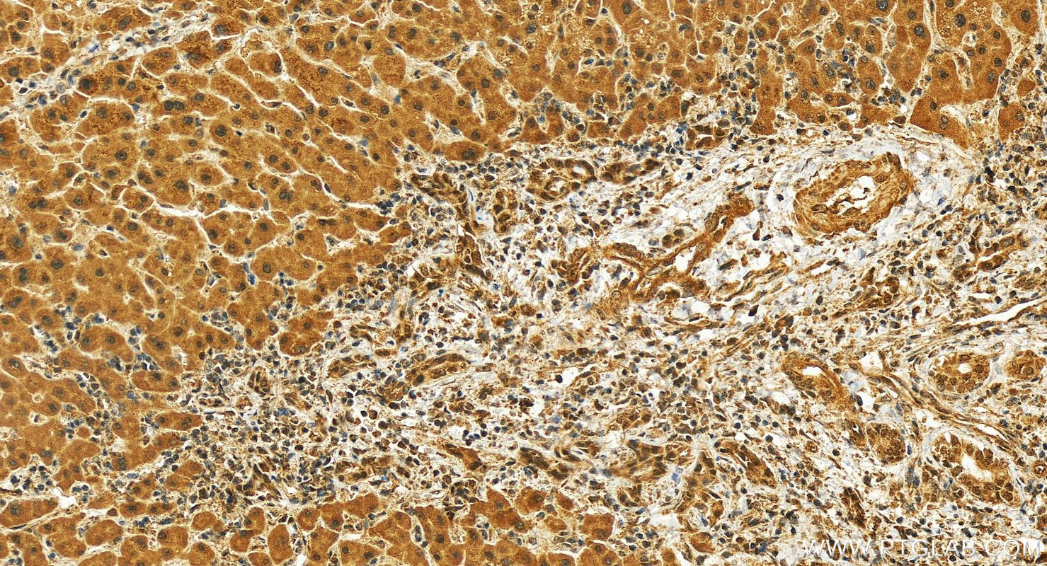 IHC staining of human intrahepatic cholangiocarcinoma using 26747-1-AP