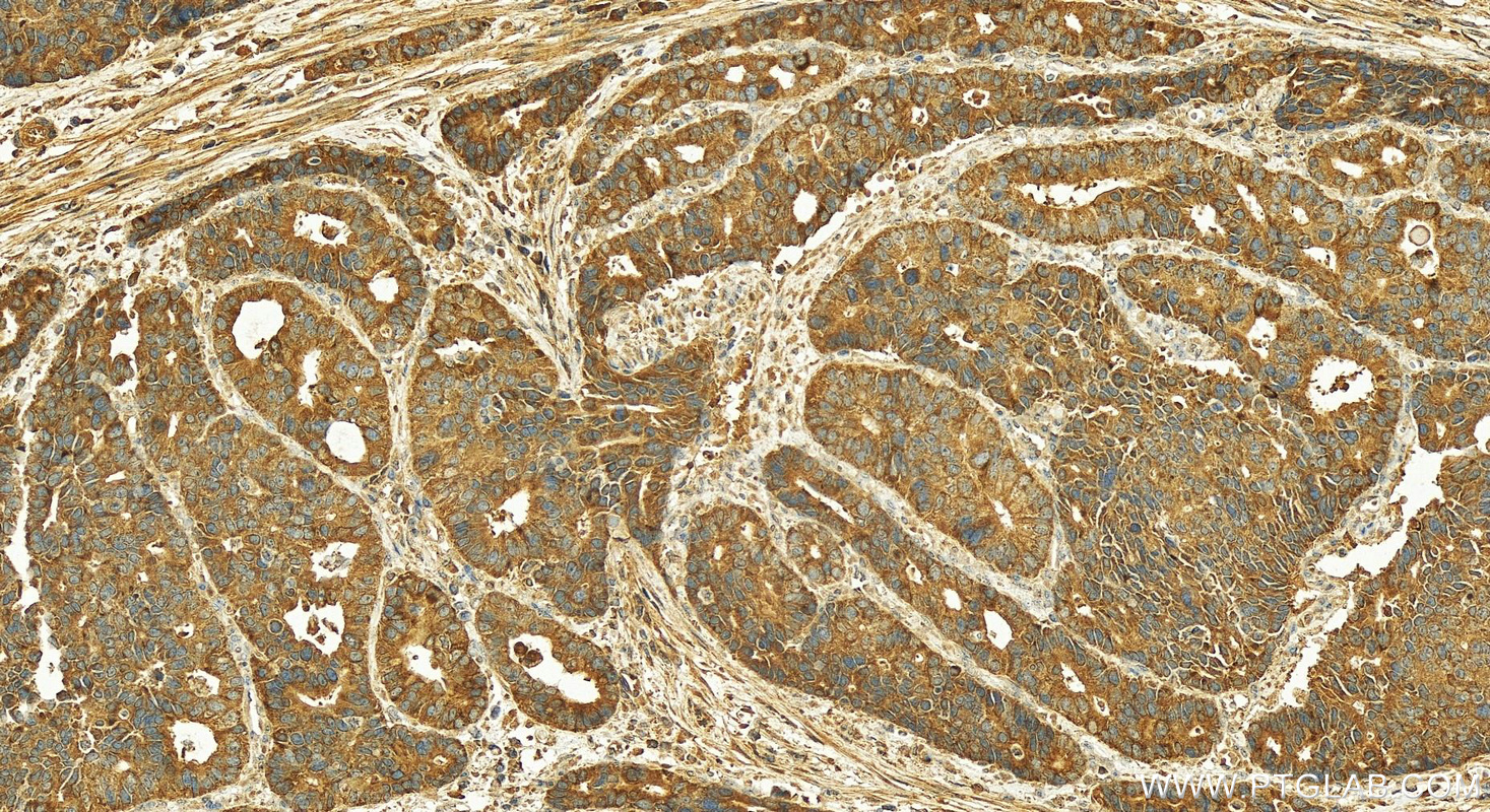 IHC staining of human stomach cancer using 16036-1-AP