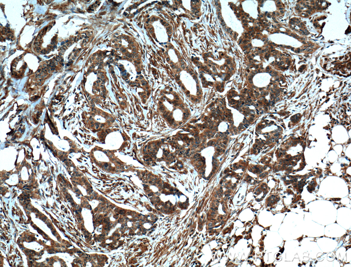 IHC staining of human breast cancer using 20226-1-AP