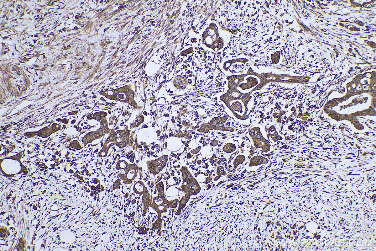 IHC staining of human pancreas cancer using 68204-1-Ig (same clone as 68204-1-PBS)