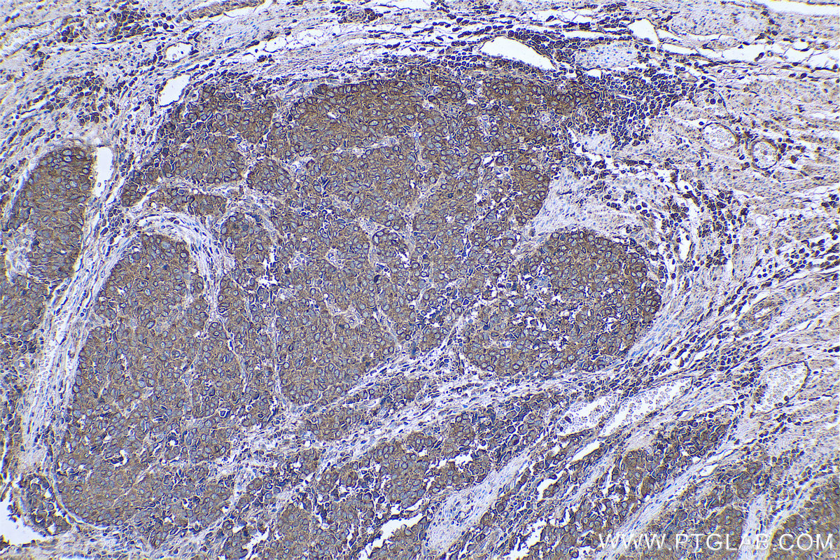 IHC staining of human stomach cancer using 68204-1-Ig (same clone as 68204-1-PBS)