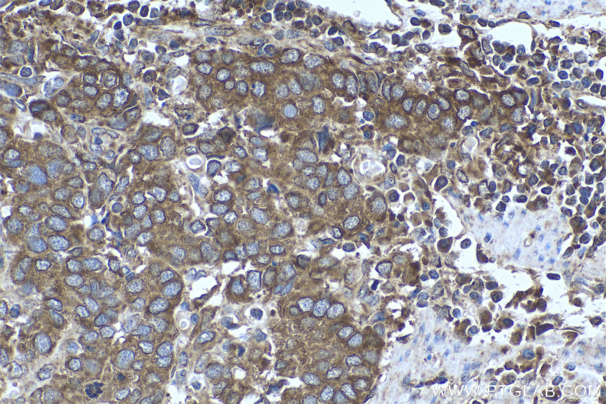 IHC staining of human stomach cancer using 68204-1-Ig (same clone as 68204-1-PBS)