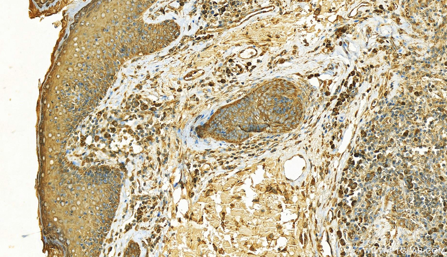 IHC staining of human skin cancer using 20227-1-AP