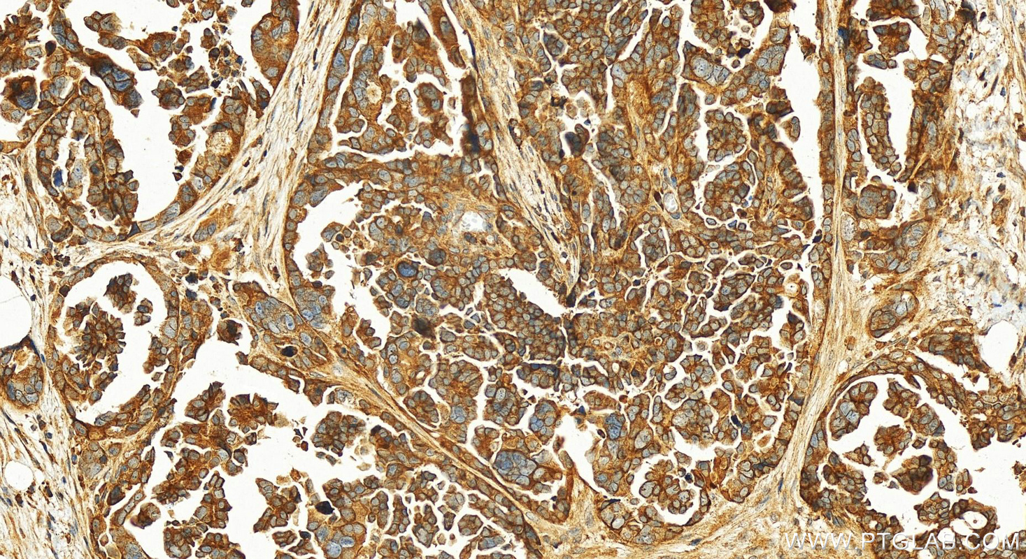 IHC staining of human ovary cancer using 22183-1-AP