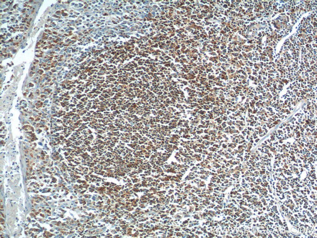 IHC staining of human tonsillitis using 14349-1-AP