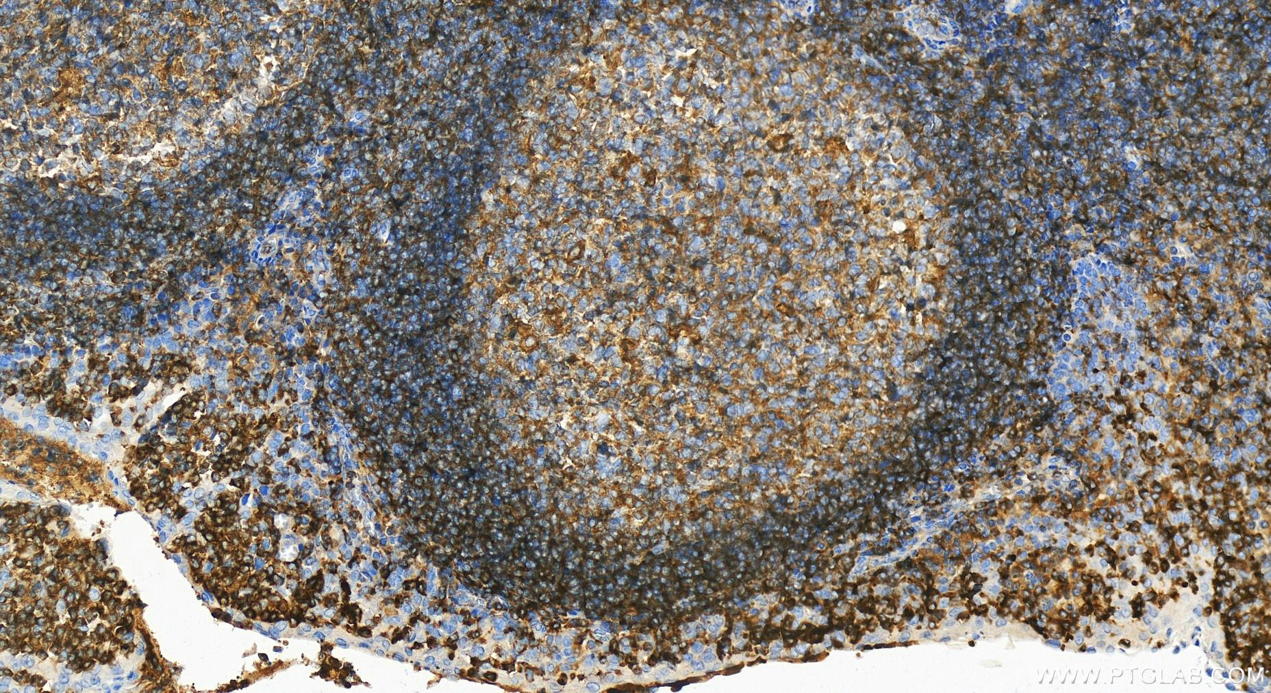 IHC staining of human tonsillitis using 14349-1-AP