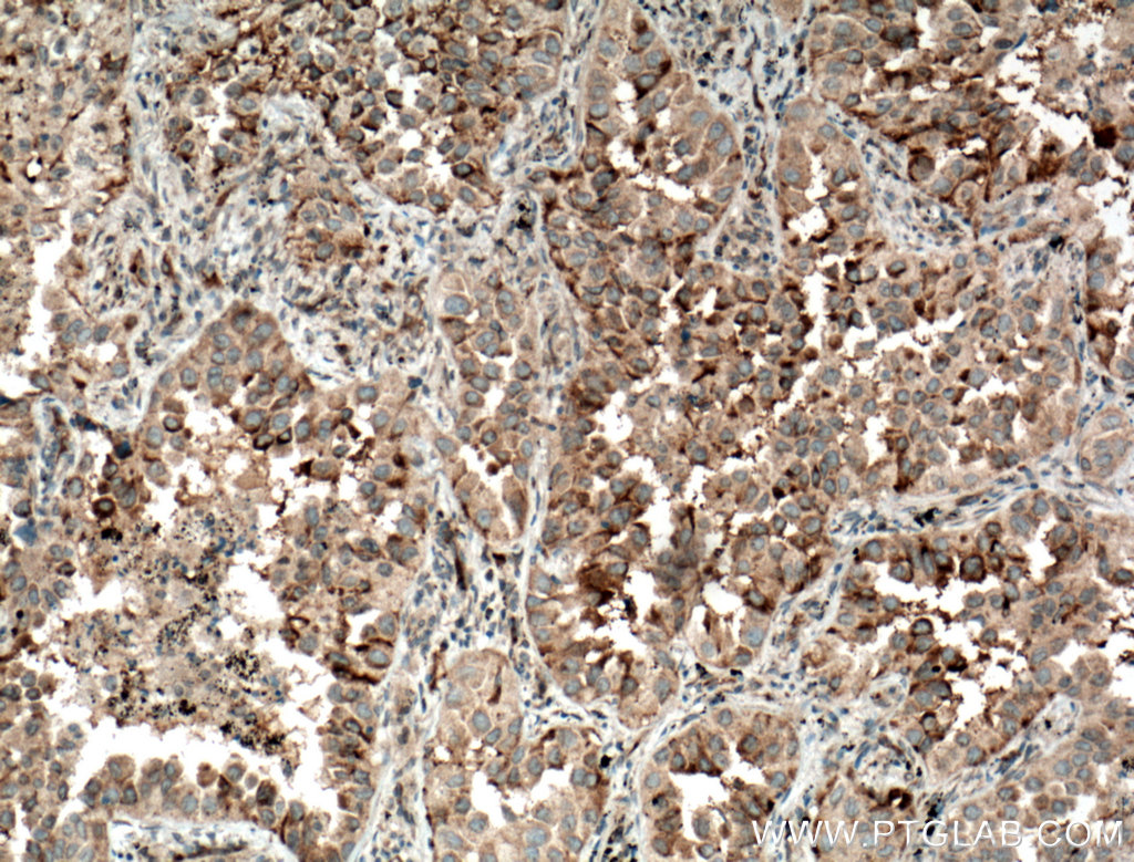 IHC staining of human lung cancer using 11112-1-AP