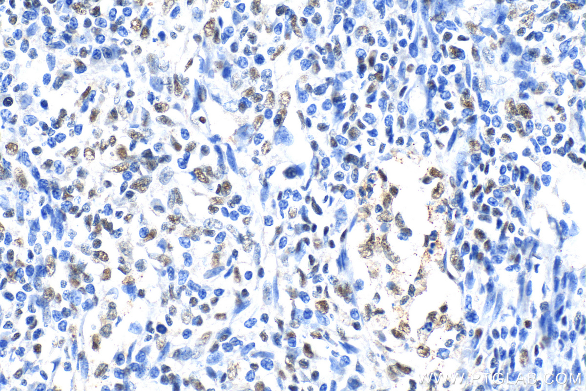 IHC staining of human endometrial cancer using 30304-1-AP