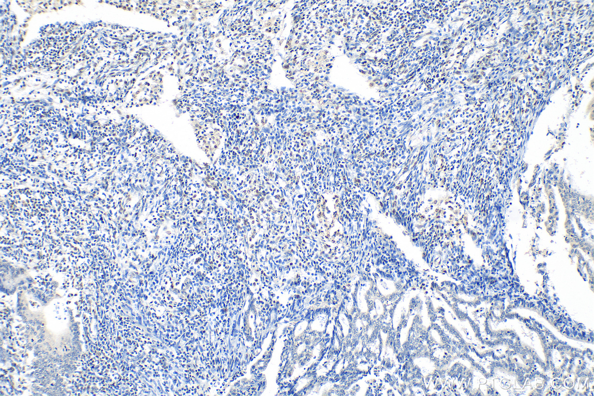 IHC staining of human endometrial cancer using 30304-1-AP